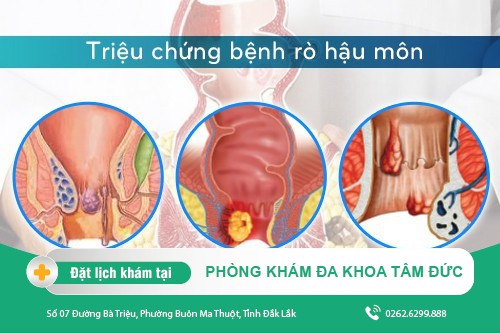 Các phương pháp điều trị rò hậu môn được áp dụng hiện nay