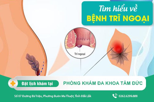 Chữa bệnh trĩ ngoại - Những điều cần biết