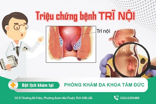 Trĩ nội có những biểu hiện nào?