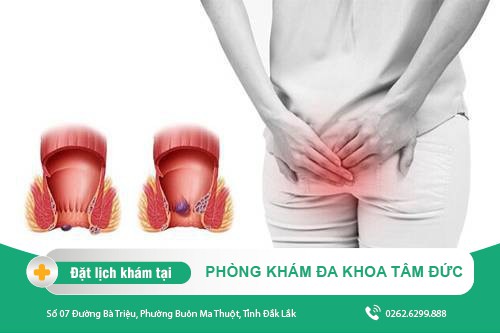 Ỉa rát đít nguyên do vì sao - Cách khắc phục