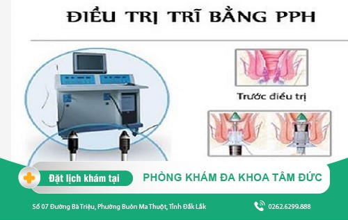 Tìm hiểu thuốc điều trị bệnh trĩ ngoại