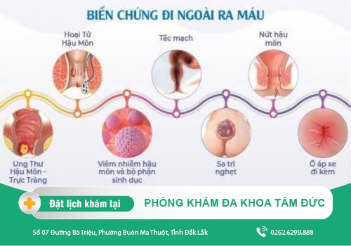 Cách trị đi cầu ra máu bằng dân gian