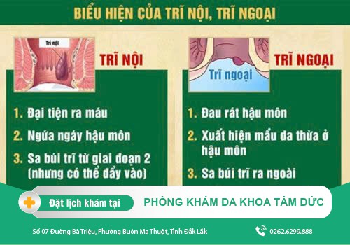 Cách chữa bệnh trĩ tại Đắk Lắk - Phẫu thuật mổ trĩ ở đâu an toàn tại Đắk Lắk?